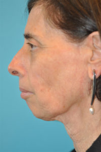 Facelift and Necklift Before and After Photos