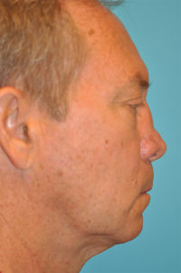 Revision Rhinoplasty Before and After Photos