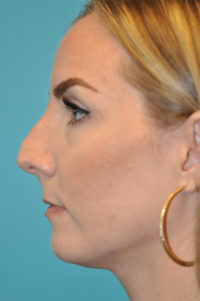 Rhinoplasty (Nose Job) Before and After Photos