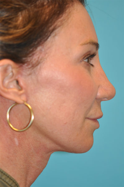 Facelift and Necklift Before and After Photos Case 5892 After Photo Facelift and Necklift Before and After Photos