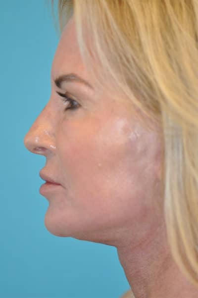 Facelift and Necklift Before and After Photos