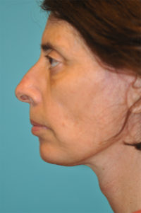Facelift and Necklift Before and After Photos