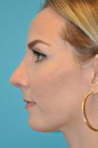 Rhinoplasty (Nose Job) Before and After Photos