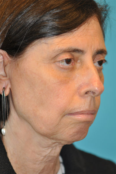 Facelift and Necklift Before and After Photos