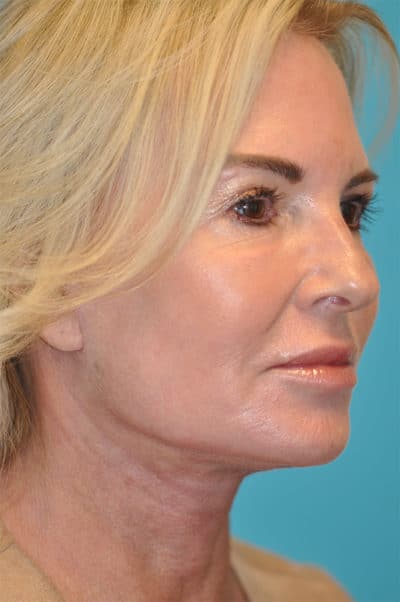 Facelift and Necklift Before and After Photos