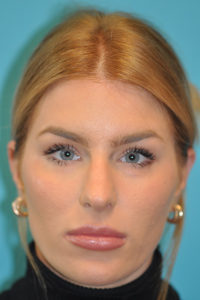 Rhinoplasty (Nose Job) Before and After Photos