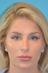 Rhinoplasty (Nose Job) Before and After Photos