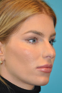 Rhinoplasty (Nose Job) Before and After Photos