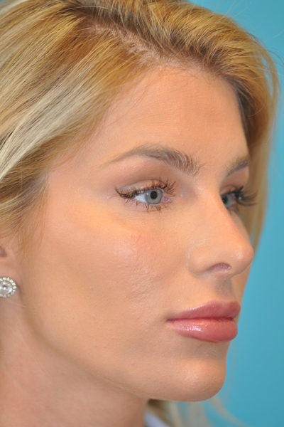 Rhinoplasty (Nose Job) Before and After Photos Case 5922 After Photo Rhinoplasty (Nose Job) Before and After Photos