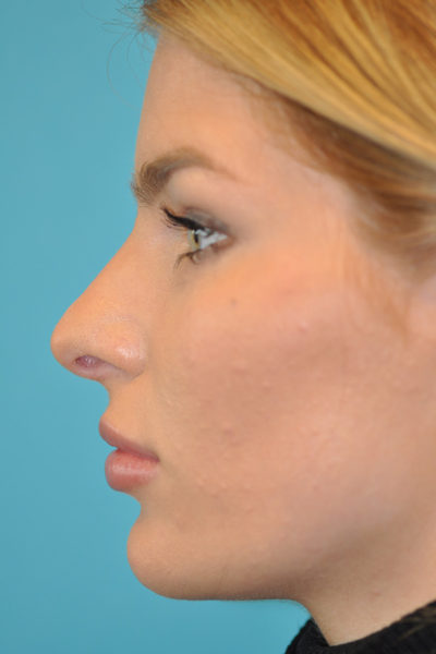 Rhinoplasty (Nose Job) Before and After Photos