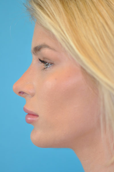 Rhinoplasty (Nose Job) Before and After Photos Case 5922 After Photo Rhinoplasty (Nose Job) Before and After Photos