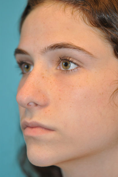 Rhinoplasty (Nose Job) Before and After Photos