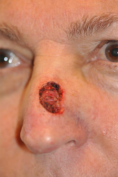 Skin Cancer Reconstruction Before and After Photos Case 5987 Before Photo Skin Cancer Reconstruction Before and After Photos