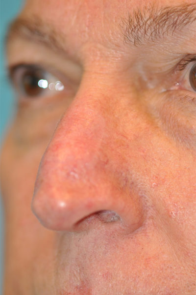 Skin Cancer Reconstruction Before and After Photos Case 5987 After Photo Skin Cancer Reconstruction Before and After Photos