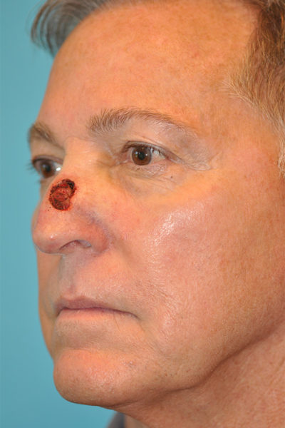 Skin Cancer Reconstruction Before and After Photos Case 5987 Before Photo Skin Cancer Reconstruction Before and After Photos