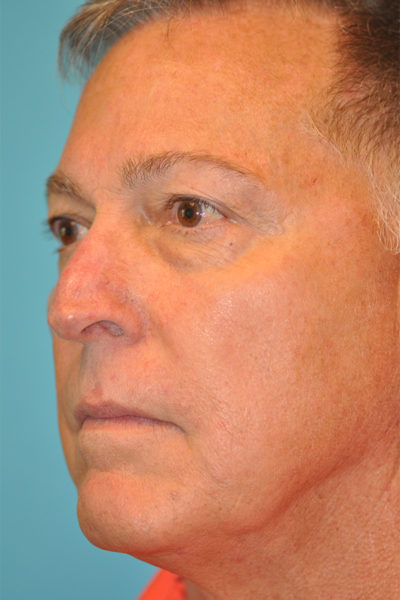 Skin Cancer Reconstruction Before and After Photos Case 5987 After Photo Skin Cancer Reconstruction Before and After Photos