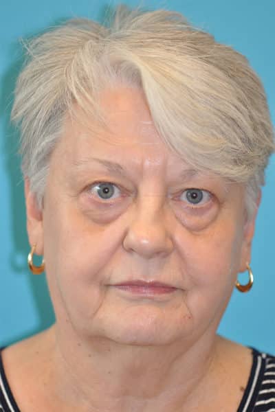 Upper Blepharoplasty (Eyelid) Before and After Photos