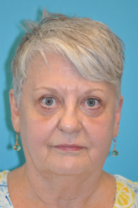 Lower Blepharoplasty (Eyelid) Before and After Photos