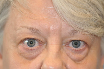 Lower Blepharoplasty (Eyelid) Before and After Photos Case 5974 Before Photo Lower Blepharoplasty (Eyelid) Before and After Photos