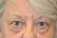 Upper Blepharoplasty (Eyelid) Before and After Photos