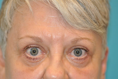 Lower Blepharoplasty (Eyelid) Before and After Photos Case 5974 After Photo Lower Blepharoplasty (Eyelid) Before and After Photos