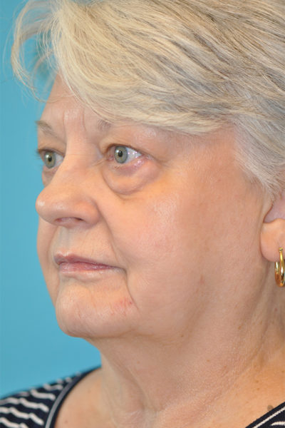 Lower Blepharoplasty (Eyelid) Before and After Photos Case 5974 Before Photo Lower Blepharoplasty (Eyelid) Before and After Photos