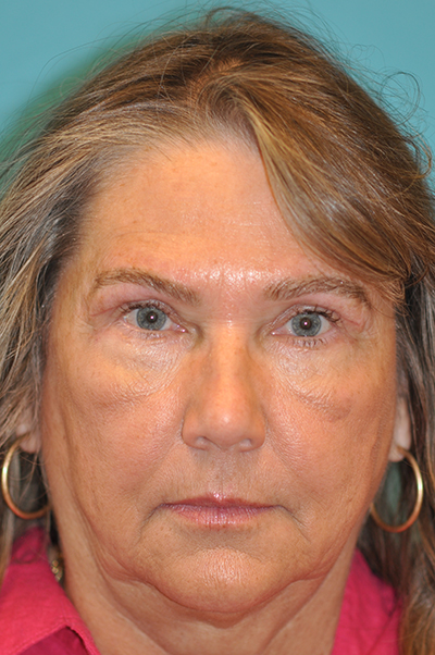 Lower Blepharoplasty (Eyelid)