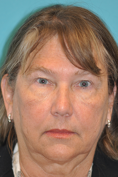 Upper Blepharoplasty (Eyelid) Before and After Photos Case 5949 Before Photo Upper Blepharoplasty (Eyelid) Before and After Photos