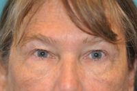 Lower Blepharoplasty (Eyelid) Before and After Photos