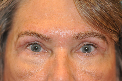 Upper Blepharoplasty (Eyelid) Before and After Photos Case 5949 After Photo Upper Blepharoplasty (Eyelid) Before and After Photos