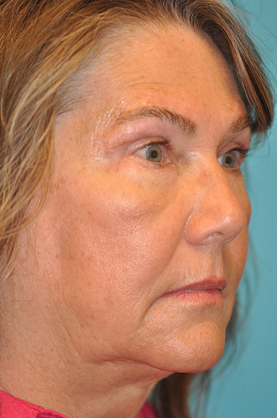 Lower Blepharoplasty (Eyelid) Before and After Photos