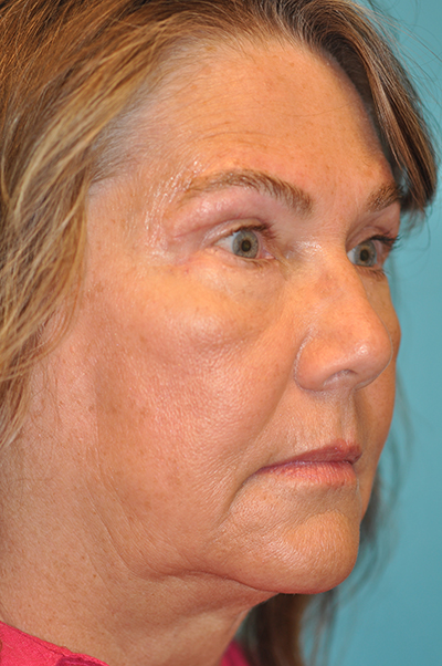 Lower Blepharoplasty (Eyelid)