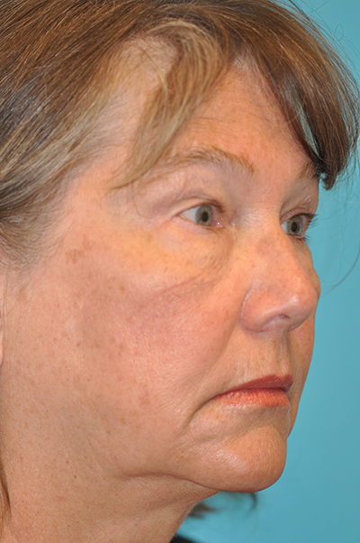 Upper Blepharoplasty (Eyelid) Before and After Photos Case 5949 Before Photo Upper Blepharoplasty (Eyelid) Before and After Photos
