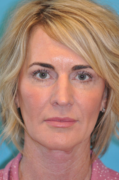 Upper Blepharoplasty (Eyelid) Before and After Photos