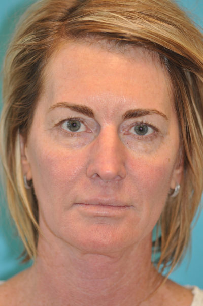 Upper Blepharoplasty (Eyelid) Before and After Photos