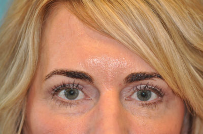 Upper Blepharoplasty (Eyelid) Before and After Photos