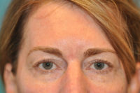 Upper Blepharoplasty (Eyelid) Before and After Photos