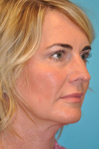 Upper Blepharoplasty (Eyelid) Before and After Photos