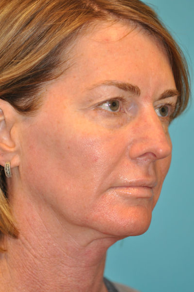 Upper Blepharoplasty (Eyelid) Before and After Photos