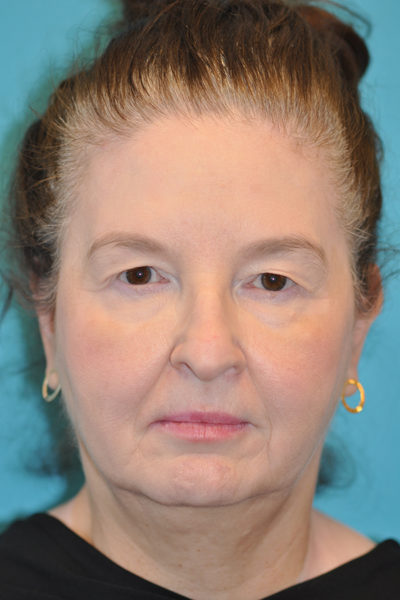 Upper Blepharoplasty (Eyelid)