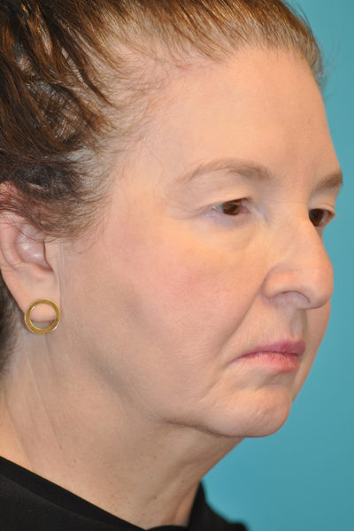 Upper Blepharoplasty (Eyelid)