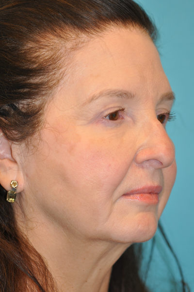 Upper Blepharoplasty (Eyelid)