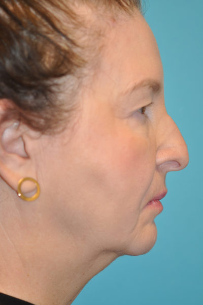 Upper Blepharoplasty (Eyelid)