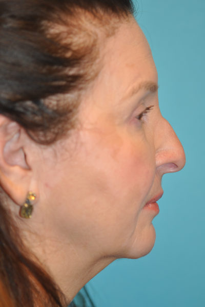 Upper Blepharoplasty (Eyelid)