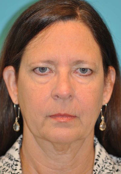 Browlift Before and After Photos Case 6068 Before Photo Browlift Before and After Photos