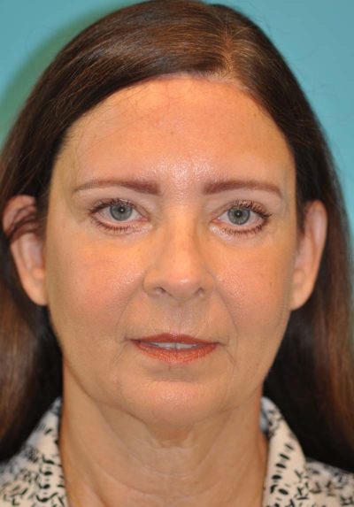 Browlift Before and After Photos Case 6068 After Photo Browlift Before and After Photos