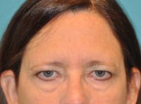 Browlift Before and After Photos