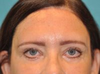 Browlift Before and After Photos