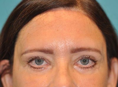Browlift Before and After Photos Case 6068 After Photo Browlift Before and After Photos