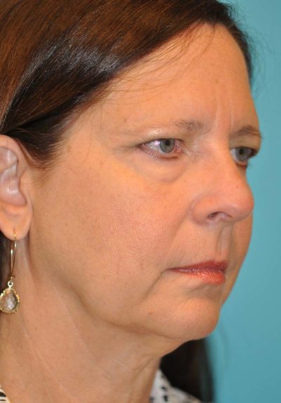 Browlift Before and After Photos Case 6068 Before Photo Browlift Before and After Photos